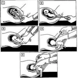 Coathanger Abortion