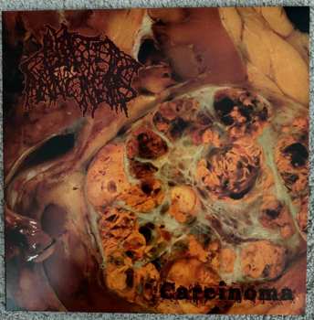 LP Blasted Pancreas: Carcinoma CLR | LTD
